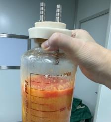 漳州水动力吸脂手术要做多久？
